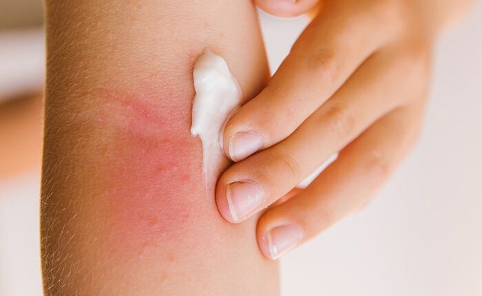 Irritación en la piel por fricción: cuidados y tratamientos - DIARIO ROATÁN